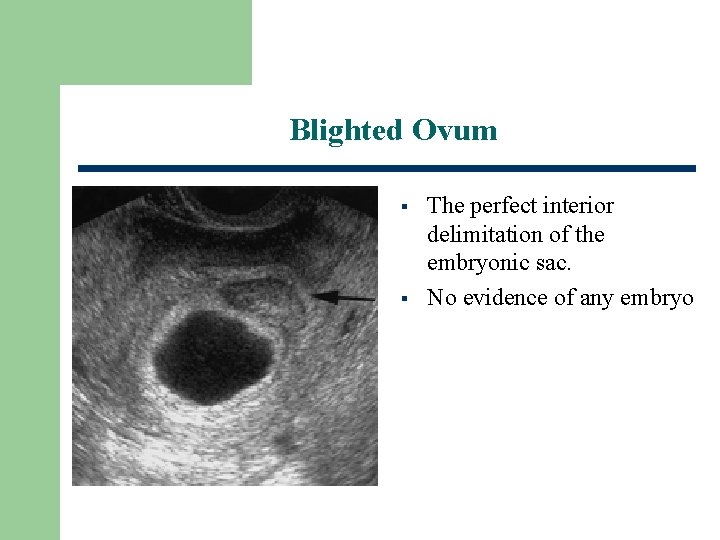 Blighted Ovum § § The perfect interior delimitation of the embryonic sac. No evidence