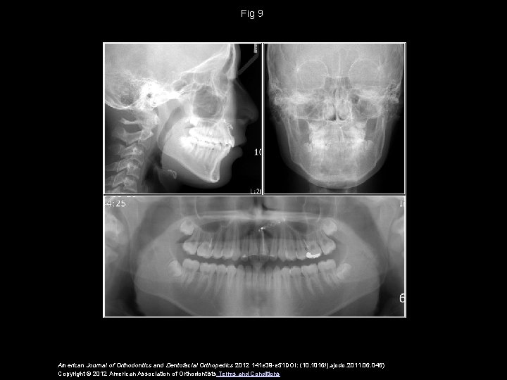 Fig 9 American Journal of Orthodontics and Dentofacial Orthopedics 2012 141 e 39 -e