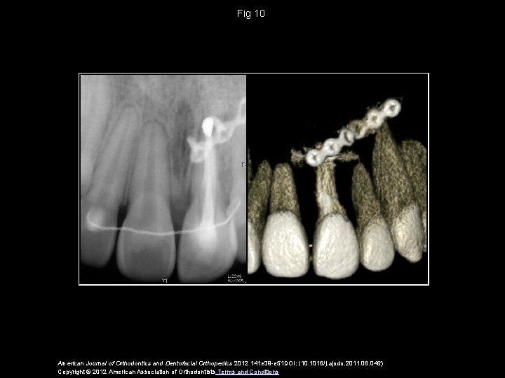 Fig 10 American Journal of Orthodontics and Dentofacial Orthopedics 2012 141 e 39 -e