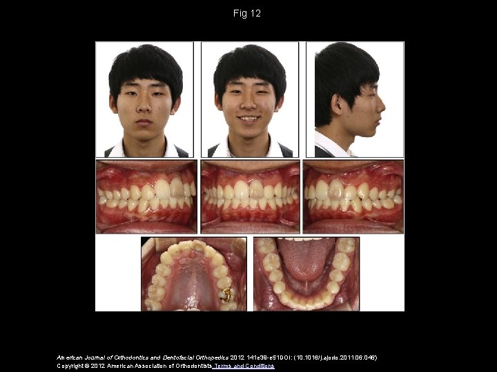 Fig 12 American Journal of Orthodontics and Dentofacial Orthopedics 2012 141 e 39 -e