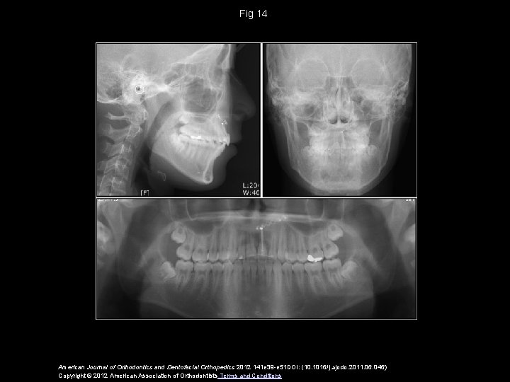 Fig 14 American Journal of Orthodontics and Dentofacial Orthopedics 2012 141 e 39 -e