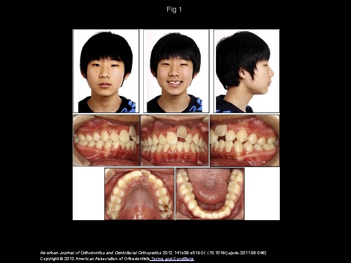 Fig 1 American Journal of Orthodontics and Dentofacial Orthopedics 2012 141 e 39 -e