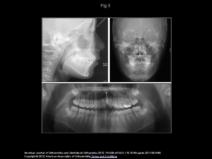 Fig 3 American Journal of Orthodontics and Dentofacial Orthopedics 2012 141 e 39 -e