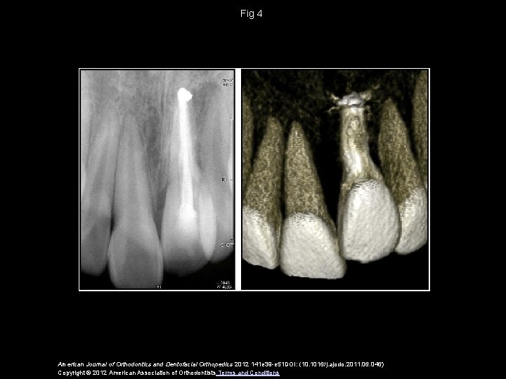 Fig 4 American Journal of Orthodontics and Dentofacial Orthopedics 2012 141 e 39 -e