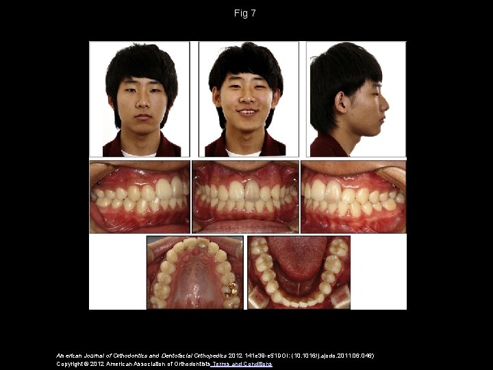 Fig 7 American Journal of Orthodontics and Dentofacial Orthopedics 2012 141 e 39 -e