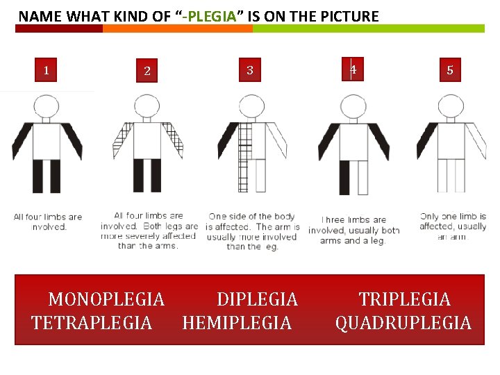 NAME WHAT KIND OF “-PLEGIA” IS ON THE PICTURE 1 2 3 MONOPLEGIA DIPLEGIA