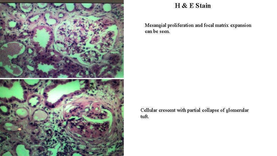 H & E Stain Mesangial proliferation and focal matrix expansion can be seen. Cellular