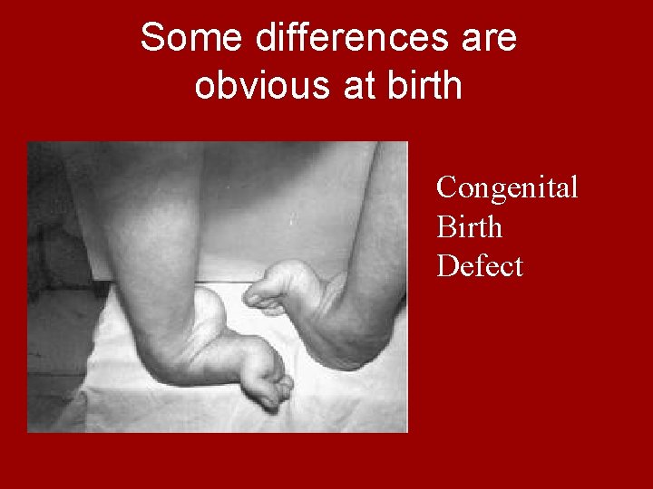 Some differences are obvious at birth Congenital Birth Defect 