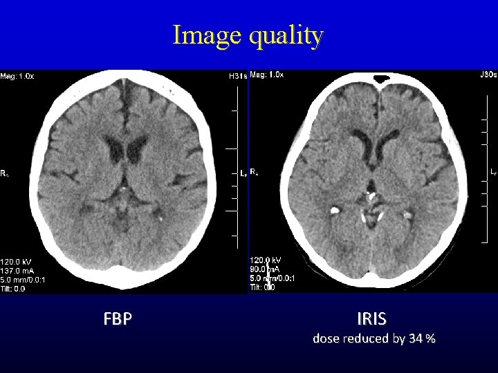 Image quality FBP IRIS dose reduced by 34 % 