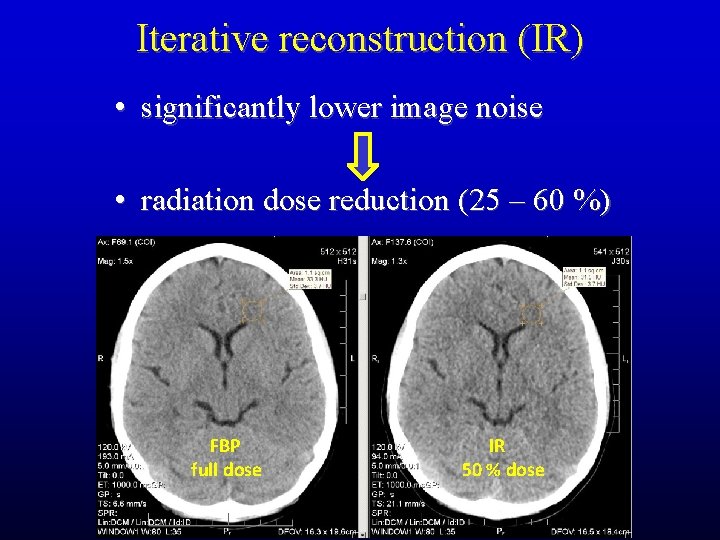 Iterative reconstruction (IR) • significantly lower image noise • radiation dose reduction (25 –