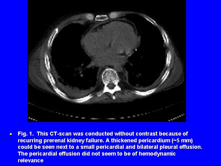 · Fig. 1. This CT-scan was conducted without contrast because of recurring prerenal kidney