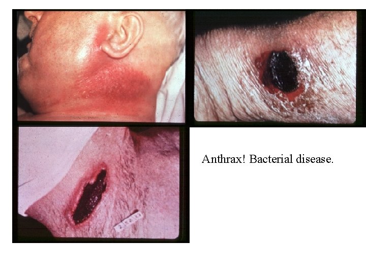 Anthrax! Bacterial disease. 