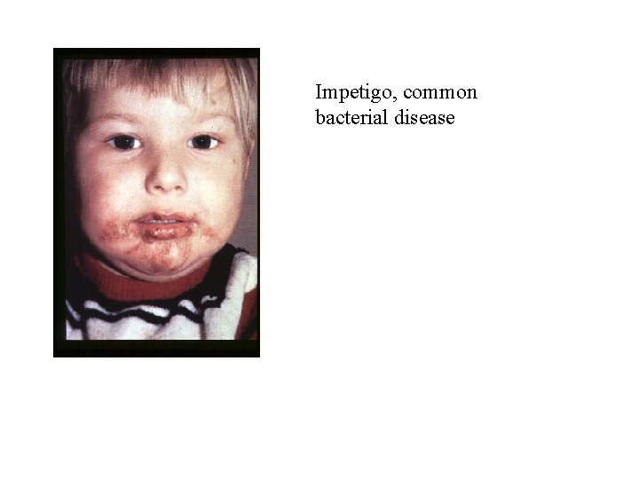 Impetigo, common bacterial disease 