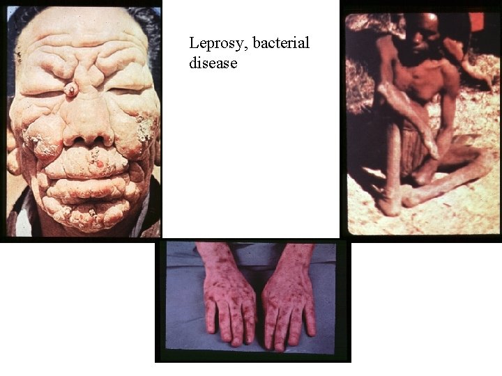 Leprosy, bacterial disease 
