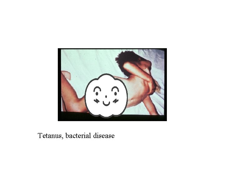 Tetanus, bacterial disease 