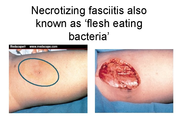 Necrotizing fasciitis also known as ‘flesh eating bacteria’ 