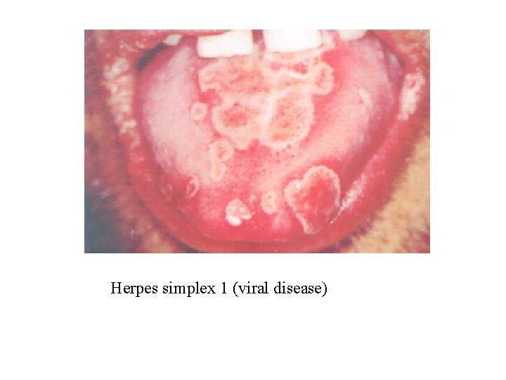 Herpes simplex 1 (viral disease) 