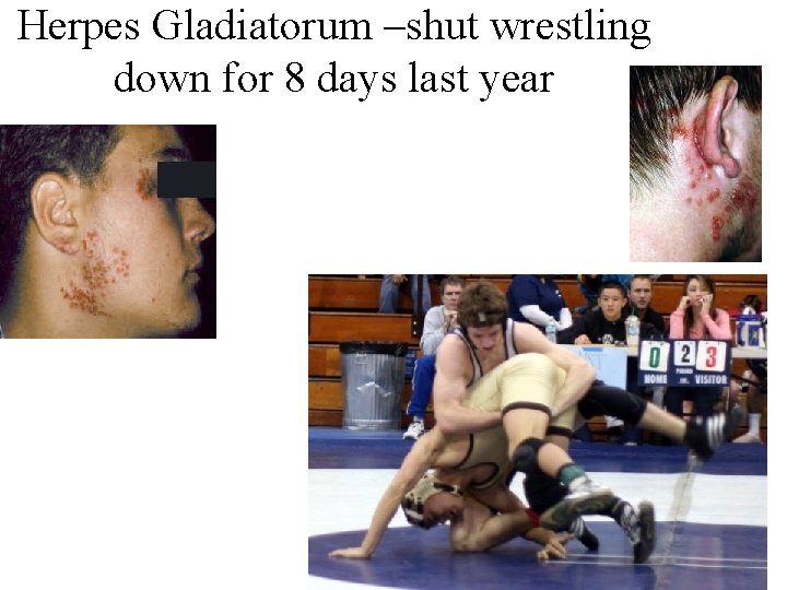 Herpes Gladiatorum –shut wrestling down for 8 days last year 