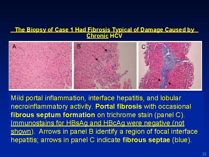 The Biopsy of Case 1 Had Fibrosis Typical of Damage Caused by Chronic HCV