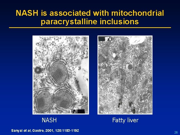 NASH is associated with mitochondrial paracrystalline inclusions NASH Sanyal et al, Gastro, 2001, 120: