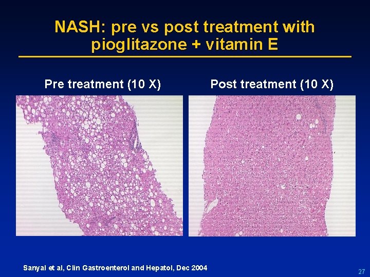 NASH: pre vs post treatment with pioglitazone + vitamin E Pre treatment (10 X)