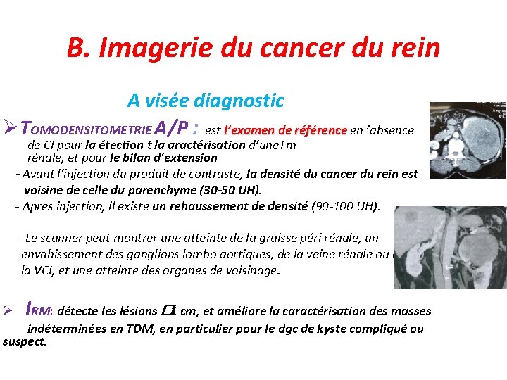 B. Imagerie du cancer du rein A visée diagnostic TOMODENSITOMETRIE A/P : est l’examen