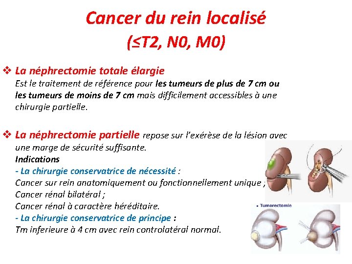 Cancer du rein localisé (≤T 2, N 0, M 0) v La néphrectomie totale