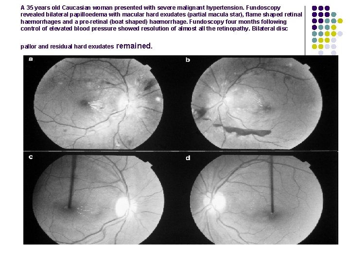 A 35 years old Caucasian woman presented with severe malignant hypertension. Fundoscopy revealed bilateral