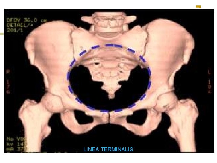 LINEA TERMINALIS 