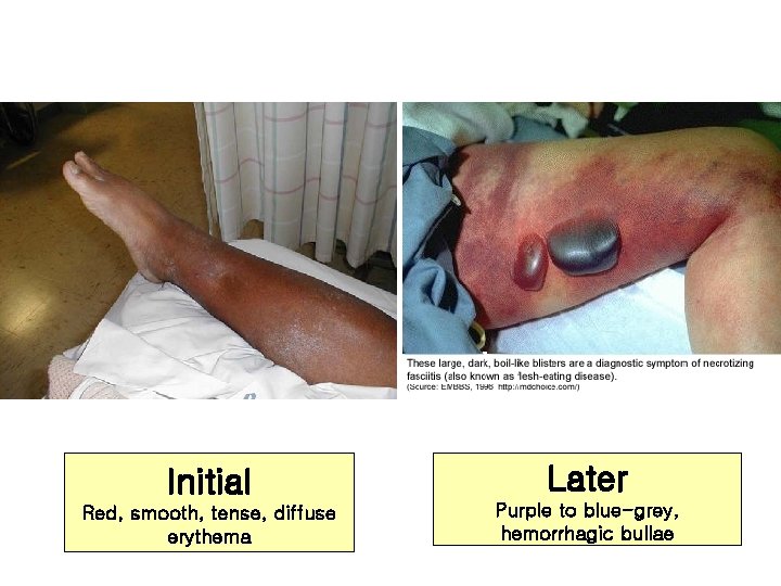 Initial Later Red, smooth, tense, diffuse erythema Purple to blue-grey, hemorrhagic bullae 