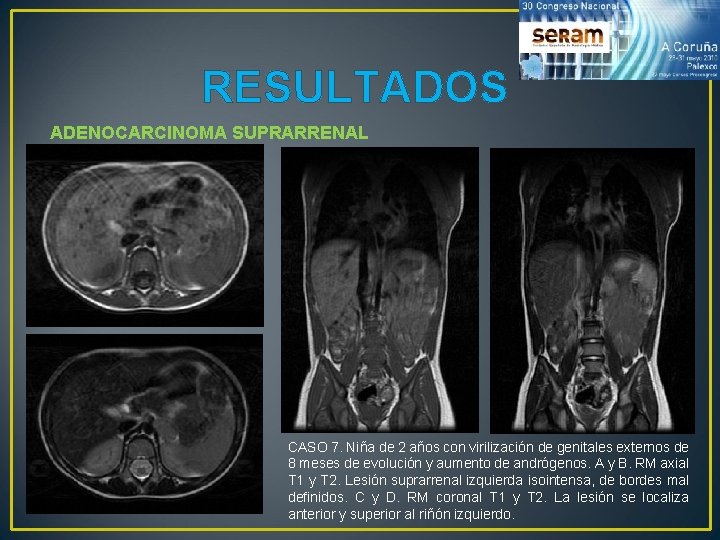 RESULTADOS ADENOCARCINOMA SUPRARRENAL CASO 7. Niña de 2 años con virilización de genitales externos