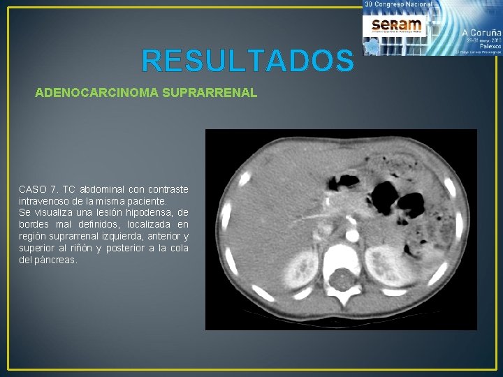 RESULTADOS ADENOCARCINOMA SUPRARRENAL CASO 7. TC abdominal contraste intravenoso de la misma paciente. Se