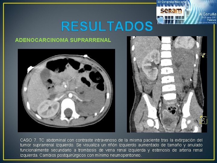 RESULTADOS ADENOCARCINOMA SUPRARRENAL CASO 7. TC abdominal contraste intravenoso de la misma paciente tras RESULTADOS ADENOCARCINOMA SUPRARRENAL CASO 7. TC abdominal contraste intravenoso de la misma paciente tras
