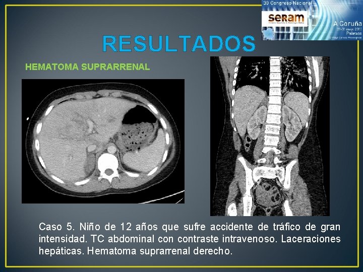 RESULTADOS HEMATOMA SUPRARRENAL Caso 5. Niño de 12 años que sufre accidente de tráfico