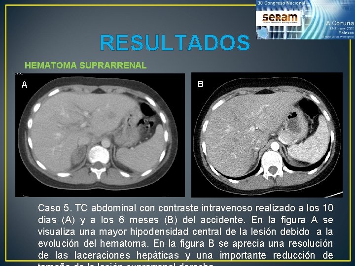 RESULTADOS HEMATOMA SUPRARRENAL A B Caso 5. TC abdominal contraste intravenoso realizado a los