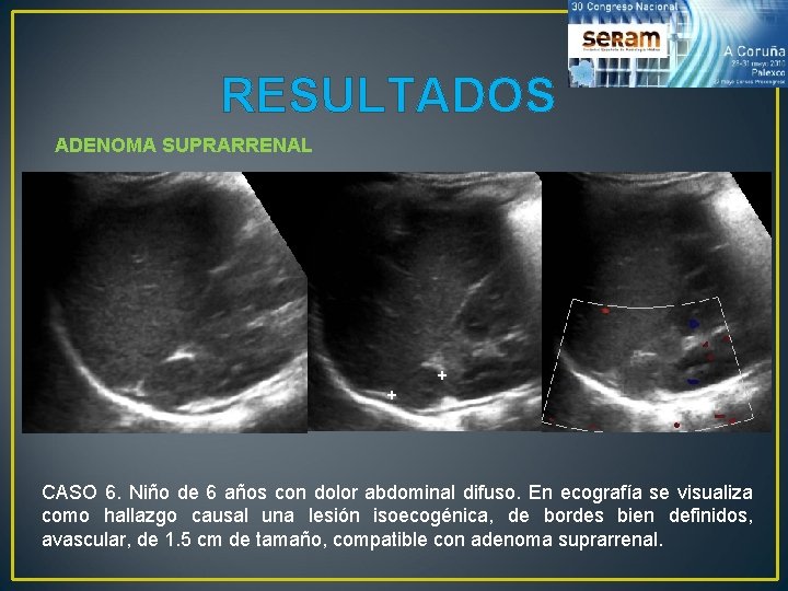 RESULTADOS ADENOMA SUPRARRENAL CASO 6. Niño de 6 años con dolor abdominal difuso. En