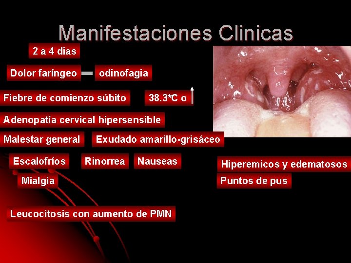 Manifestaciones Clinicas 2 a 4 dias Dolor faríngeo odinofagia Fiebre de comienzo súbito 38. Manifestaciones Clinicas 2 a 4 dias Dolor faríngeo odinofagia Fiebre de comienzo súbito 38.