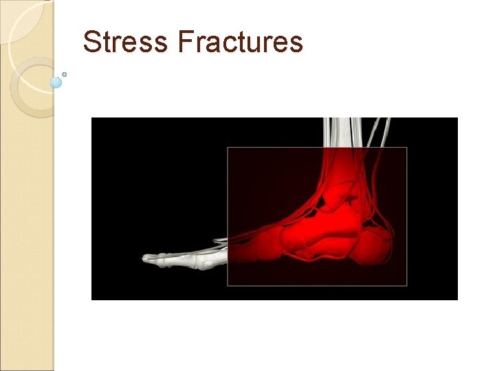 Stress Fractures 