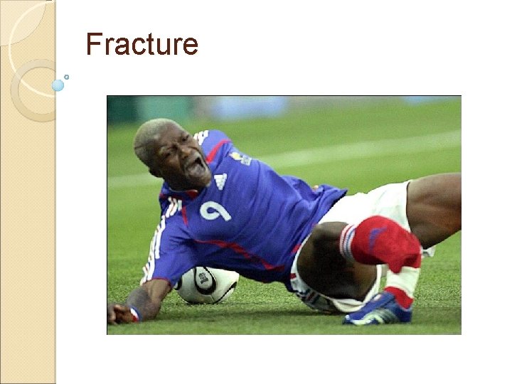 Fracture 