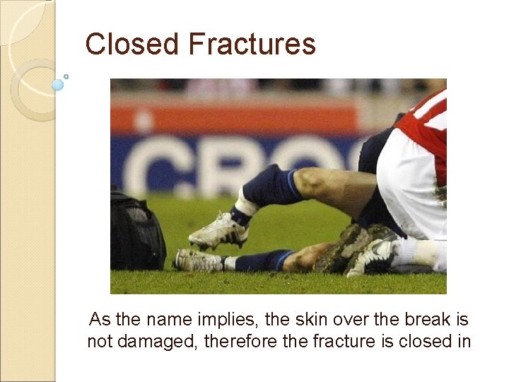 Closed Fractures As the name implies, the skin over the break is not damaged,