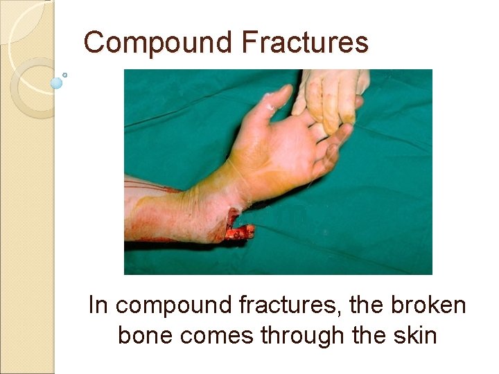 Compound Fractures In compound fractures, the broken bone comes through the skin 