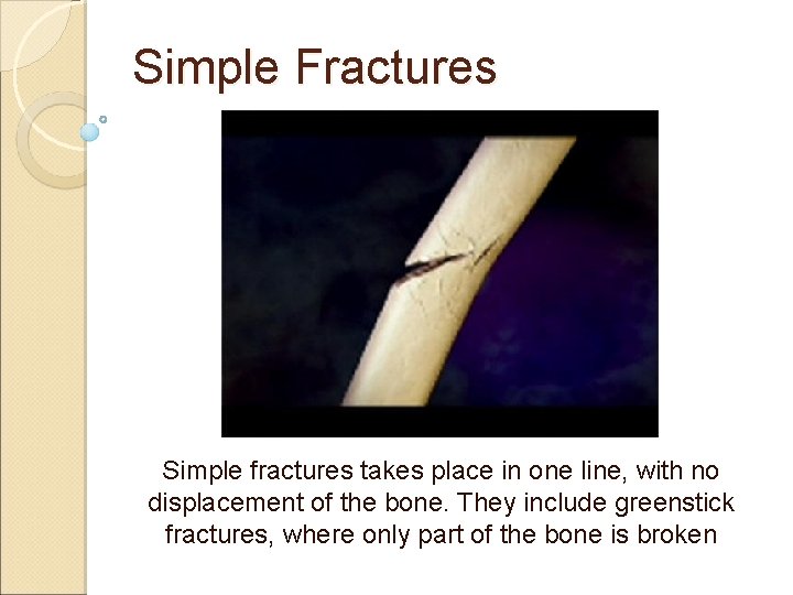 Simple Fractures Simple fractures takes place in one line, with no displacement of the