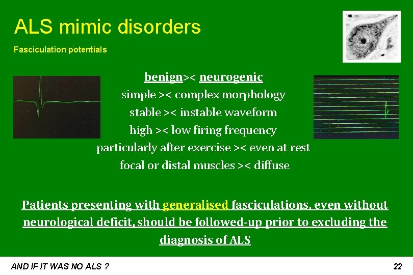 ALS mimic disorders Fasciculation potentials benign>< neurogenic simple >< complex morphology stable >< instable