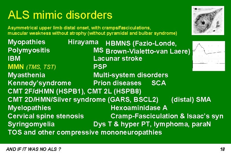 ALS mimic disorders Asymmetrical upper limb distal onset, with cramps/fasciculations, muscular weakness without atrophy