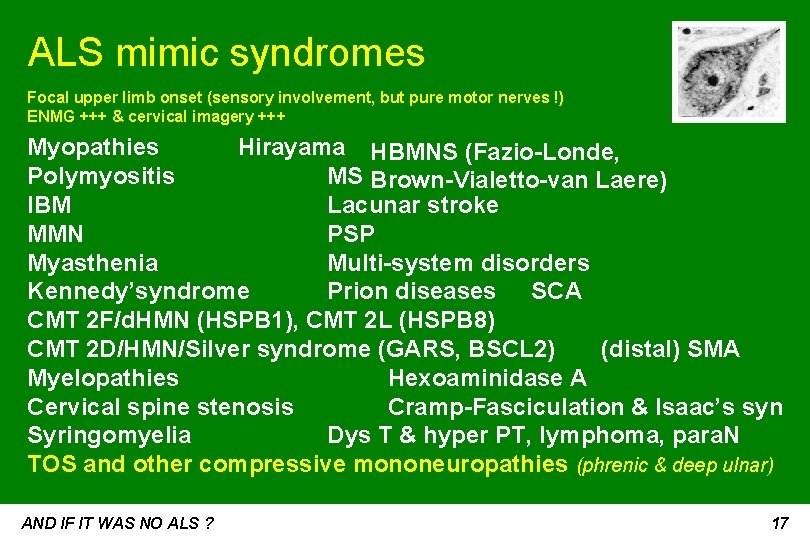 ALS mimic syndromes Focal upper limb onset (sensory involvement, but pure motor nerves !)