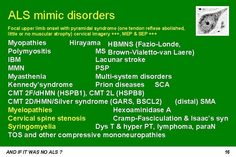 ALS mimic disorders Focal upper limb onset with pyramidal syndrome (one tendon reflexe abolished,