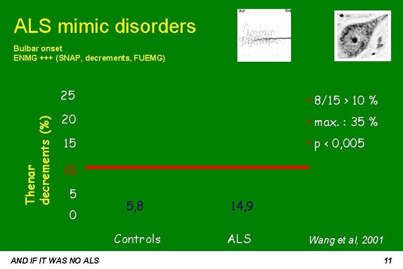 ALS mimic disorders Thenar decrements (%) Bulbar onset ENMG +++ (SNAP, decrements, FUEMG) 25