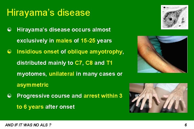 Hirayama’s disease ☯ Hirayama’s disease occurs almost exclusively in males of 15 -25 years