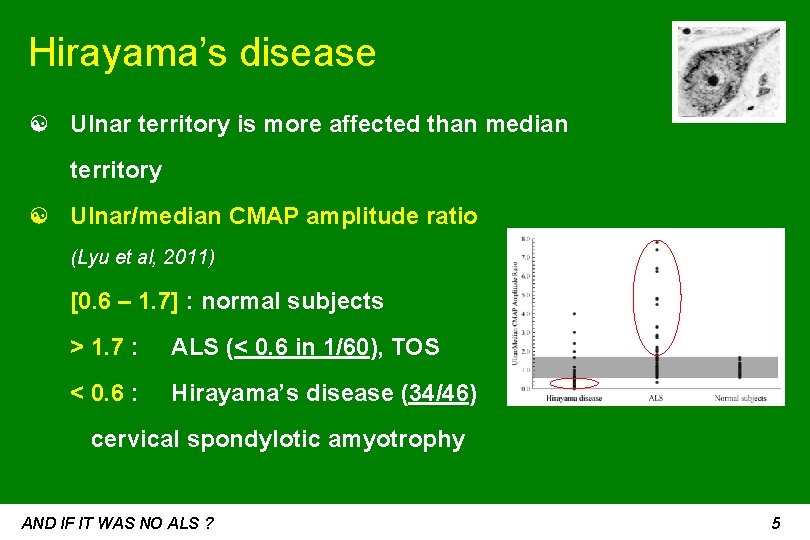 Hirayama’s disease ☯ Ulnar territory is more affected than median territory ☯ Ulnar/median CMAP