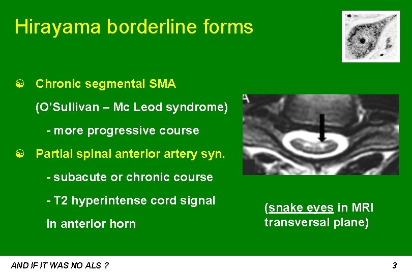 Hirayama borderline forms ☯ Chronic segmental SMA (O’Sullivan – Mc Leod syndrome) - more